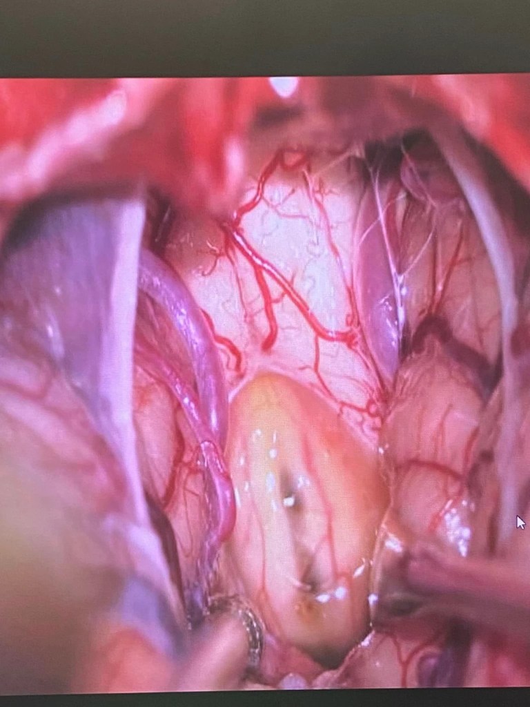 腦幹手術