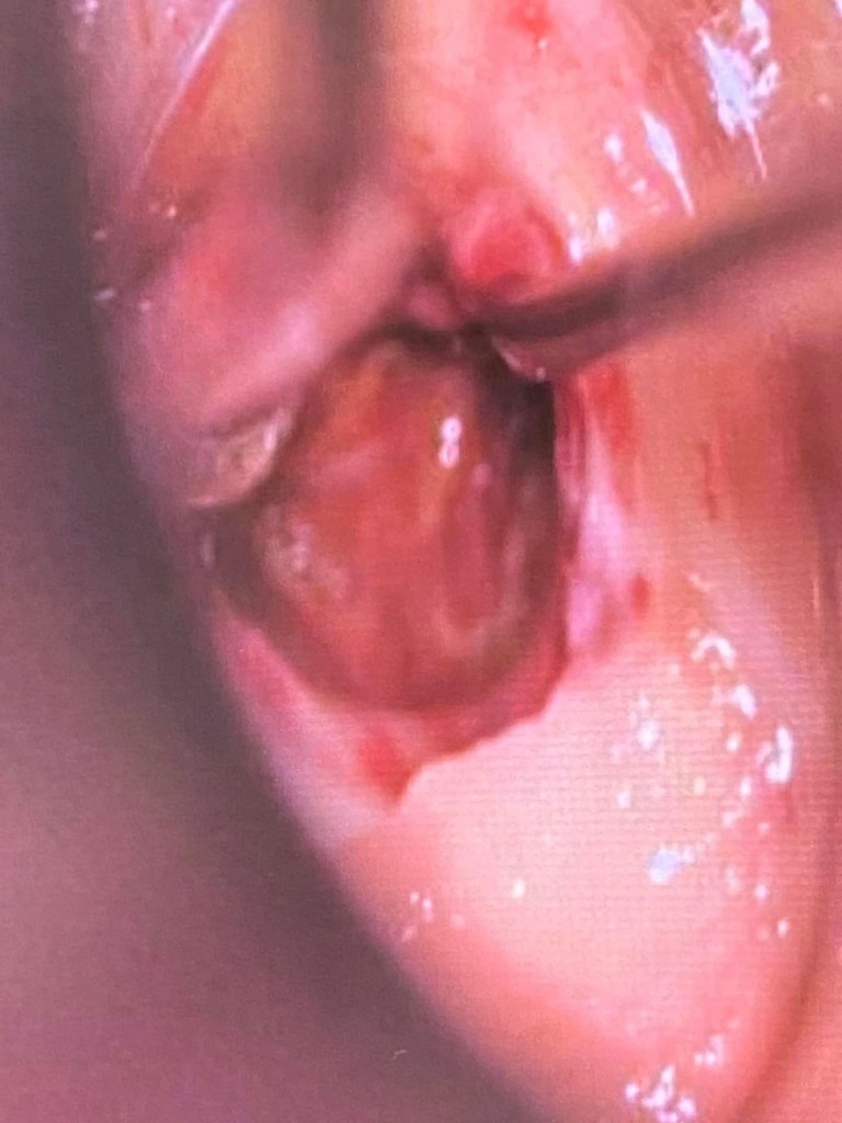 腦幹手術