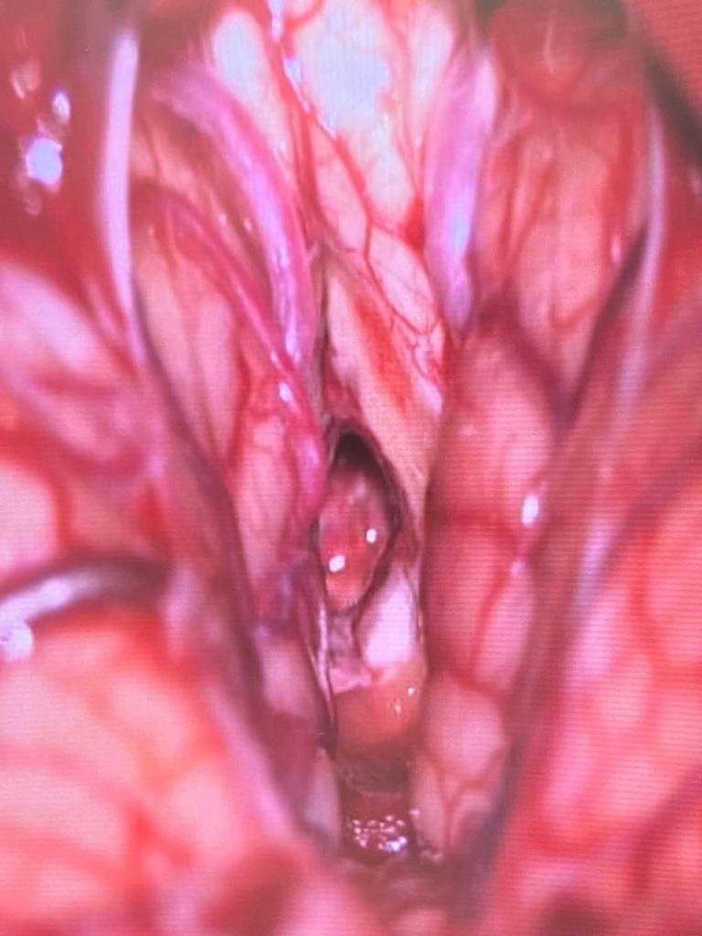 腦幹手術