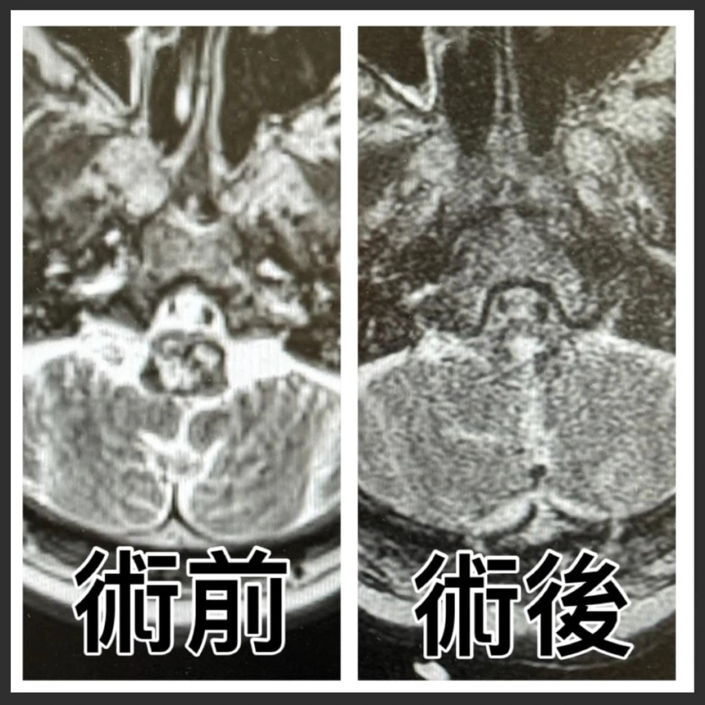 腦幹手術
