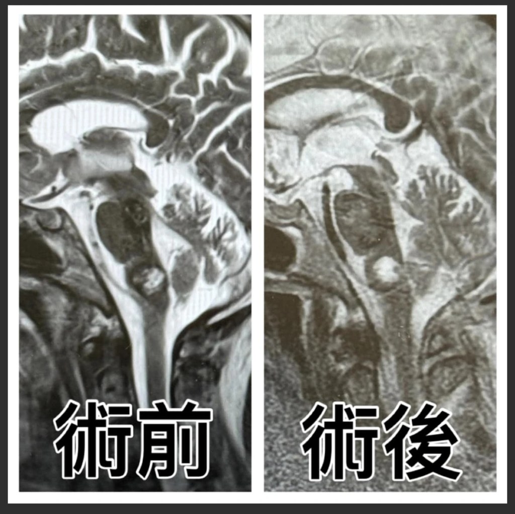 腦幹手術